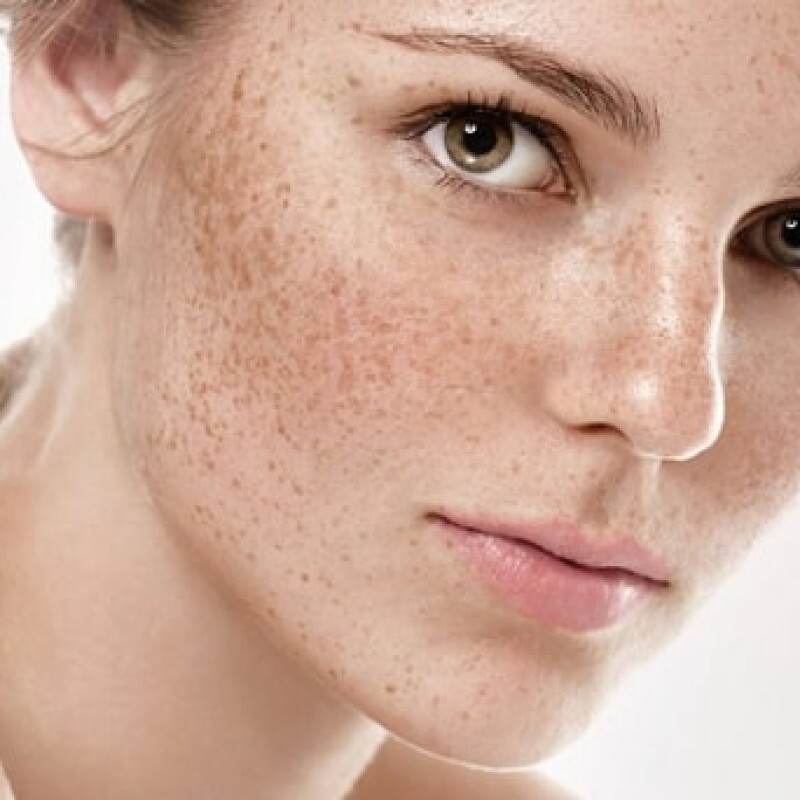 Đâu là những nguyên nhân gây nám da phổ biến ở phụ nữ?